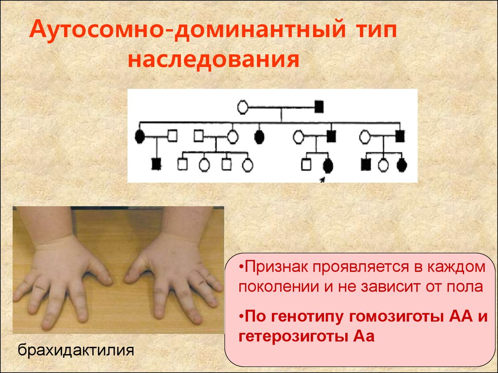 Аутосомно доминантное наследование. Аутосомно-доминантный Тип наследования заболевания. Брахидактилия болезнь наследование. Типы наследования признаков аутосомно доминантный Тип наследования. Признаки аутосомно-доминантного типа наследования.