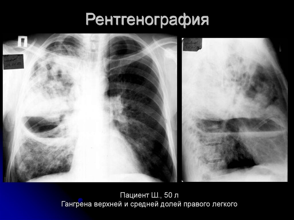 Абсцесс легкого картинки