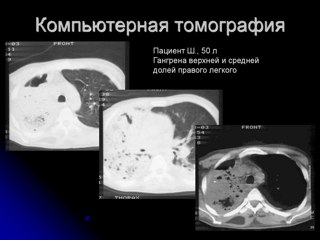 Кт легких презентация