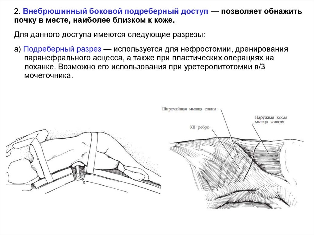 Боковой разрез. Внебрюшинный разрез Пирогова. Оперативные доступы к мочеточнику.