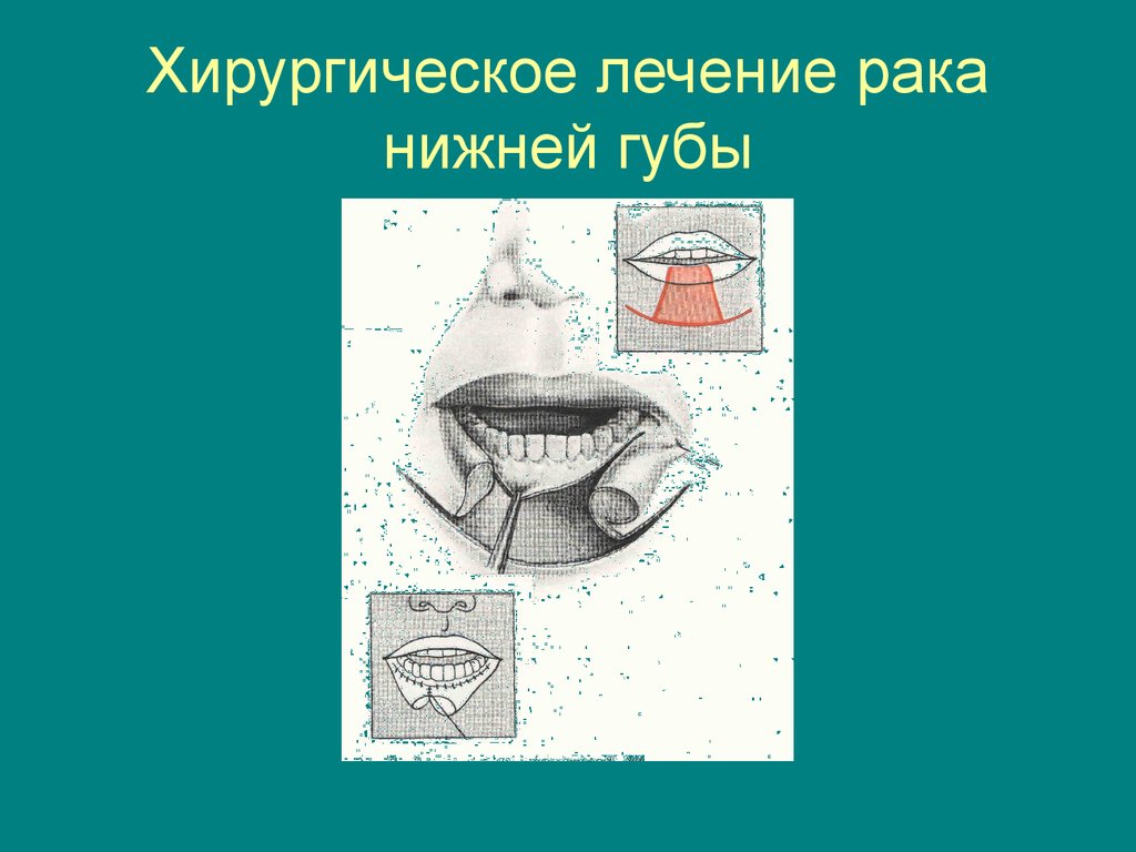 Операция нижней губы. Трапециевидная резекция нижней губы. Хирургическое иссечение карциномы губы.
