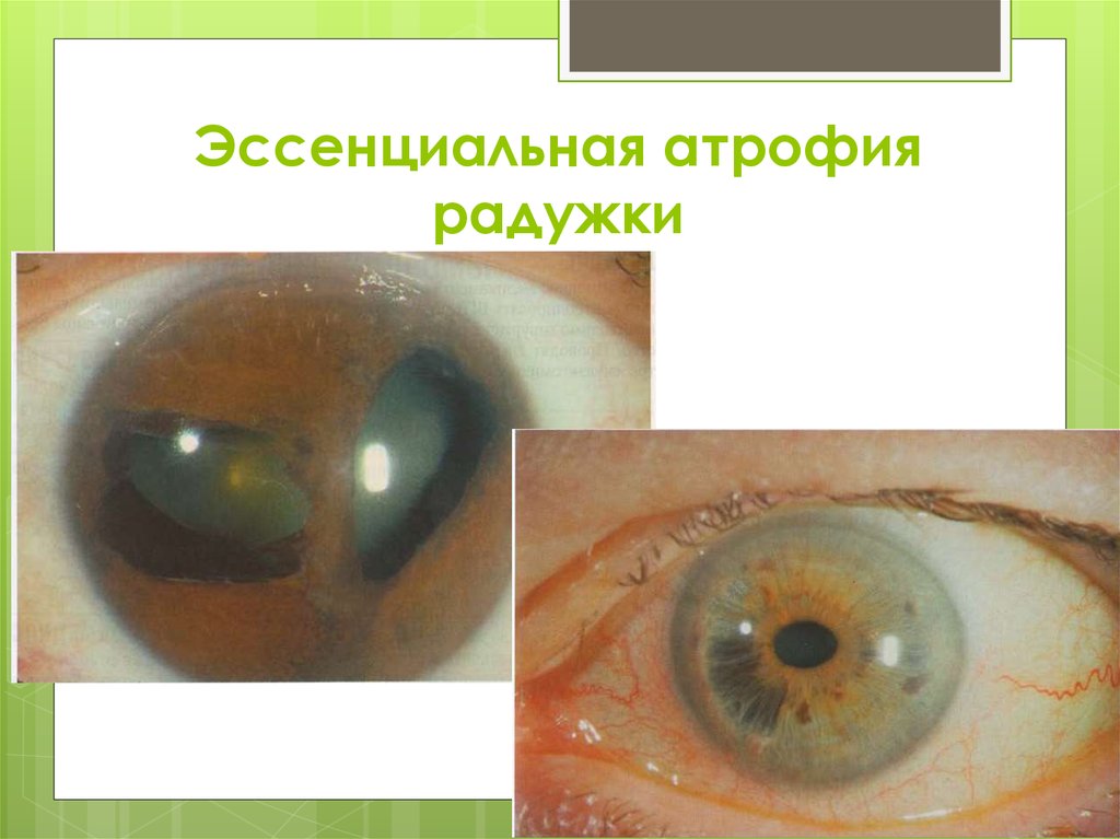 Эссенциальная атрофия радужки