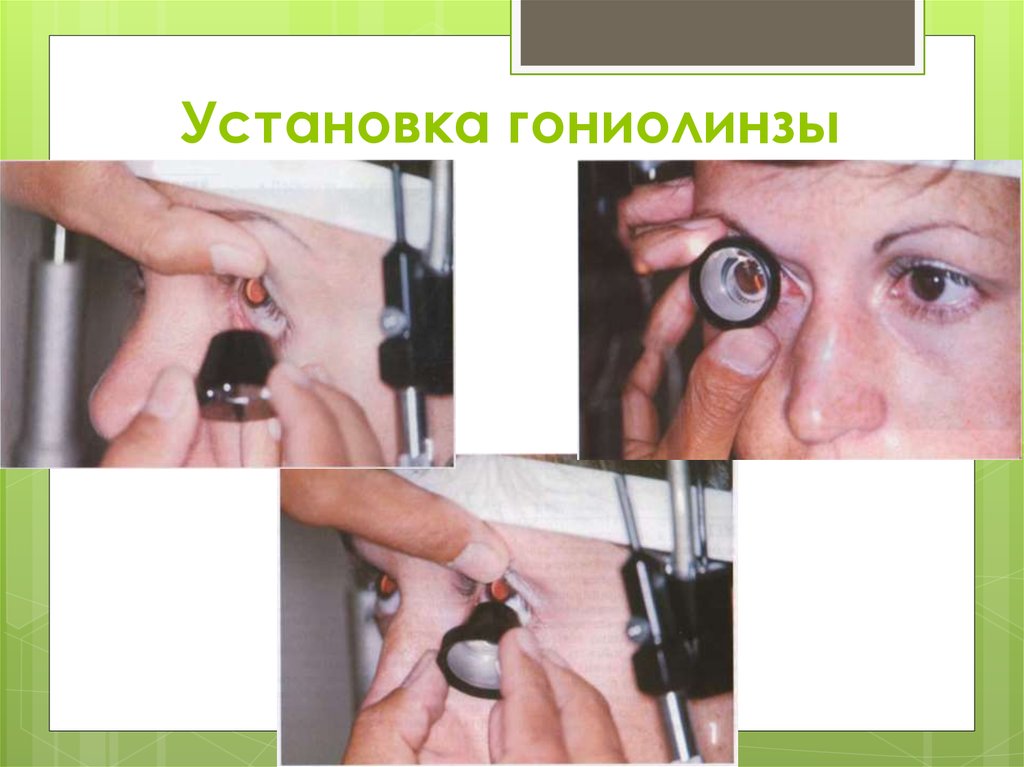 Установка гониолинзы