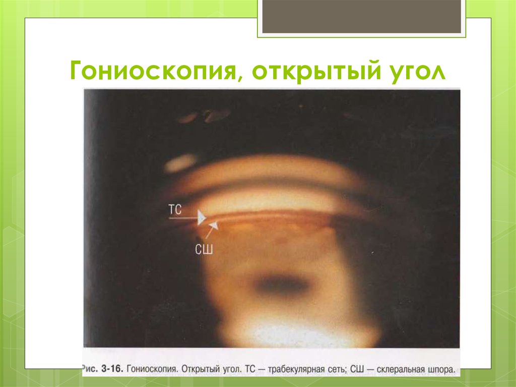 Гониоскопия, открытый угол