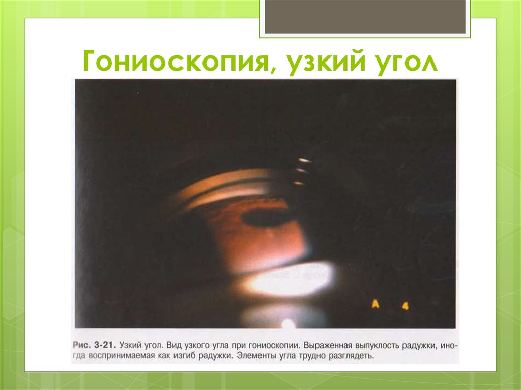 Гониоскопия, узкий угол