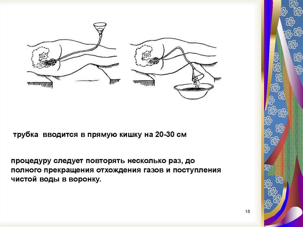 Схема классификация клизм