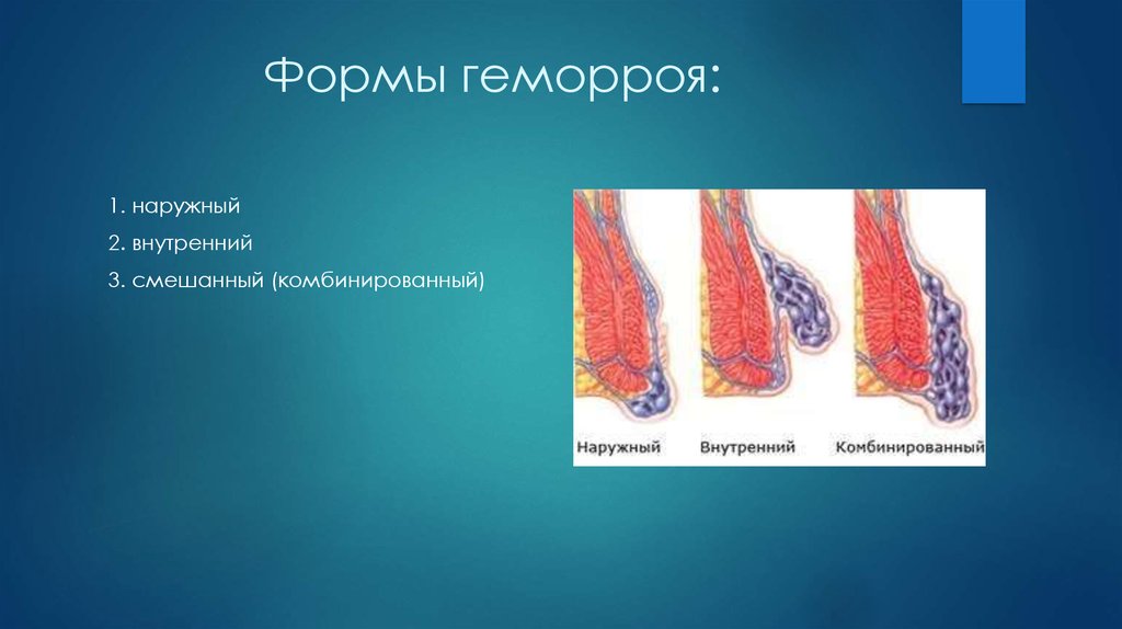 Геморрой влияет на потенцию. Гистология геморройного узла. Наружная и внутренняя форма геморроя. Тромбоз внутренних и наружных геморроидальных узлов.