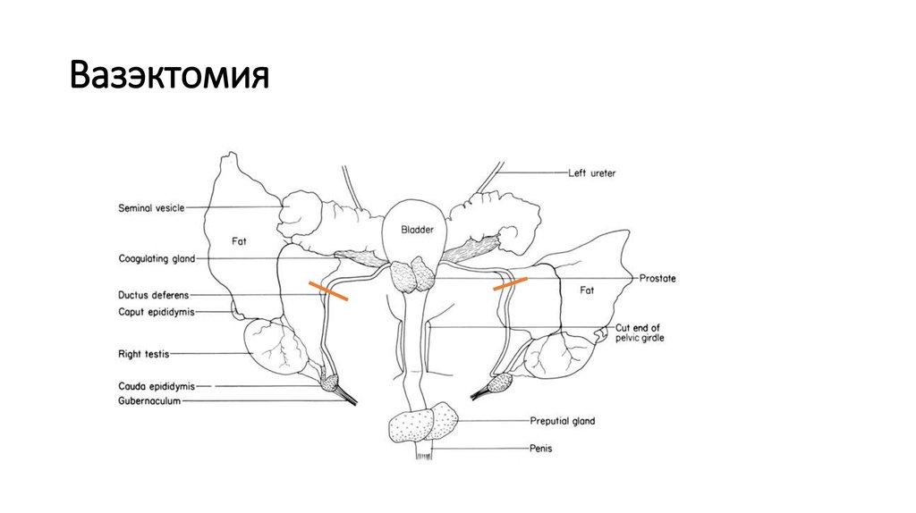 Вазэктомия