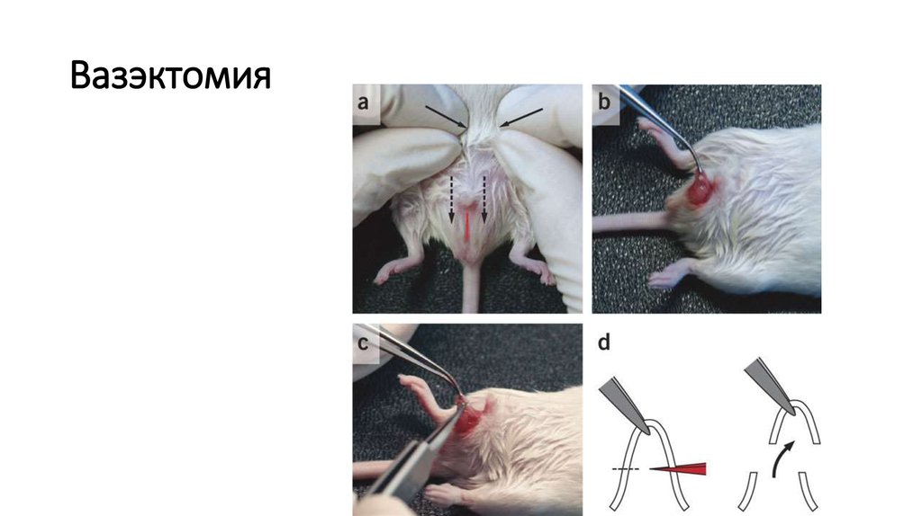 Вазэктомия