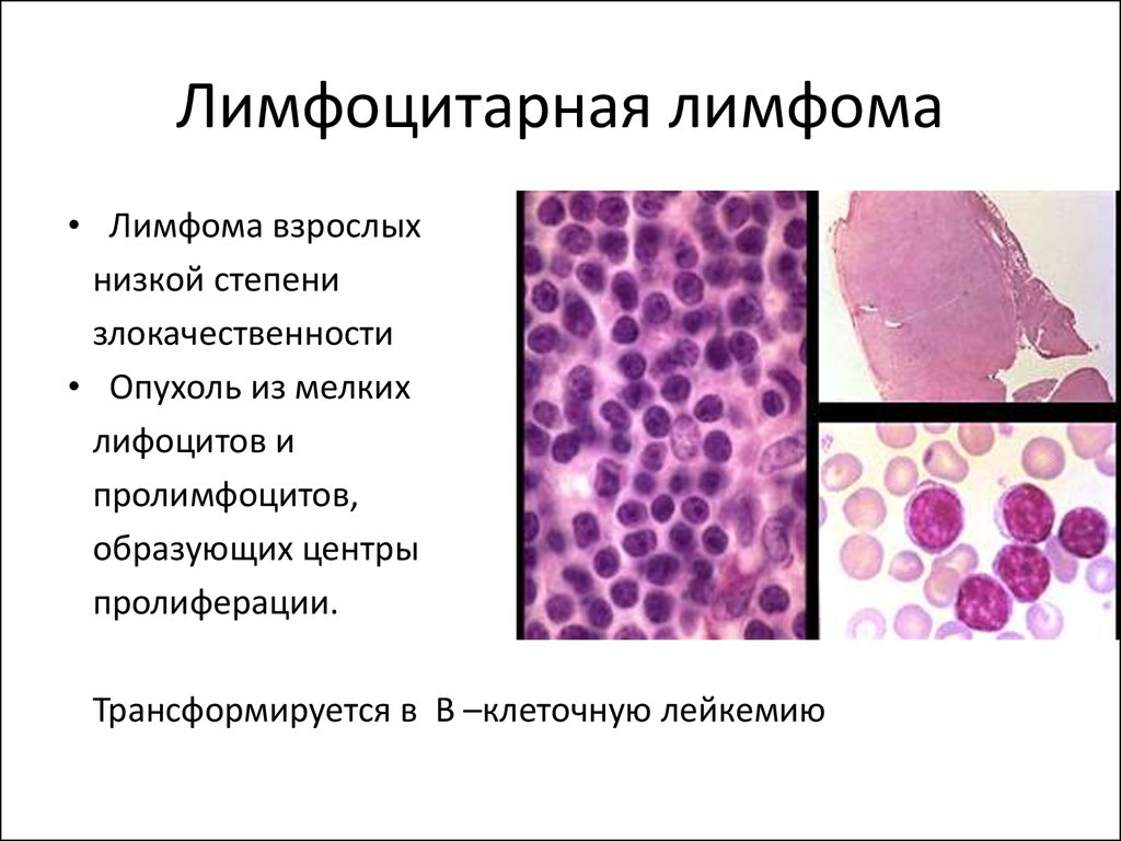 Фолликулярная лимфома стадии