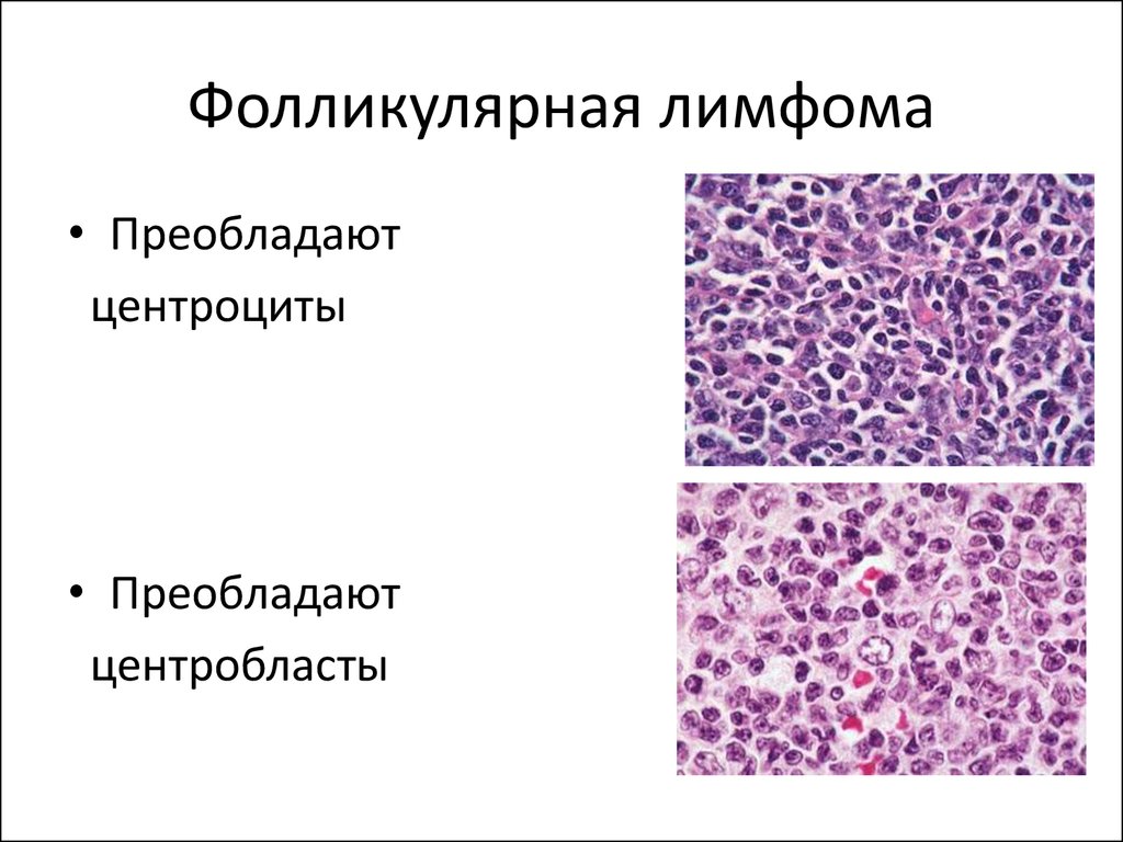 Диффузная в клеточная лимфома клинические рекомендации