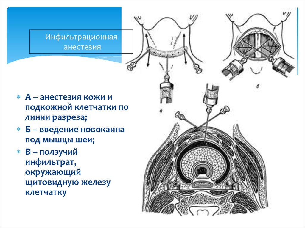 Механизм инфильтрации. Местная инфильтрационная анестезия по Вишневскому. Инфильтрационная анестезия в хирургии. Инфильтрационная анестезия при резекции щитовидной железы.