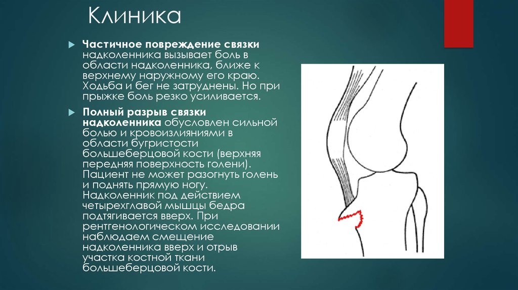 Повреждение связки надколенника. Верхний край надколенника. Частичный надрыв связки надколенника. Частичное повреждение собственной связки надколенника.