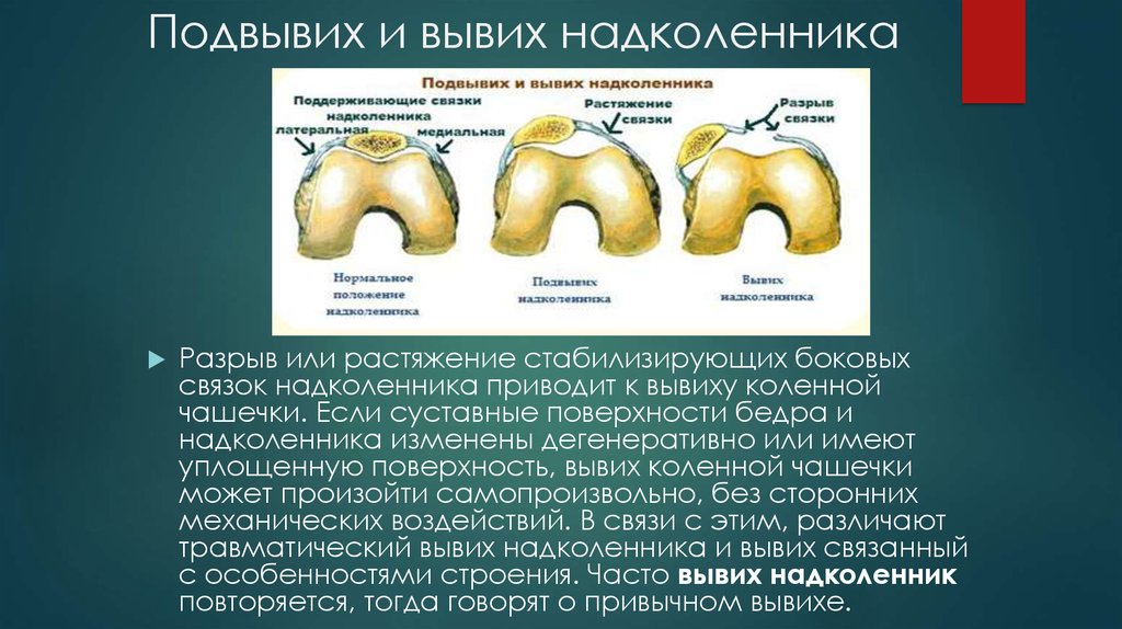 Подвывих. Диспластический вывих надколенника. Wiberg надколенник. Наружный вывих надколенника. Боковой вывих надколенника.