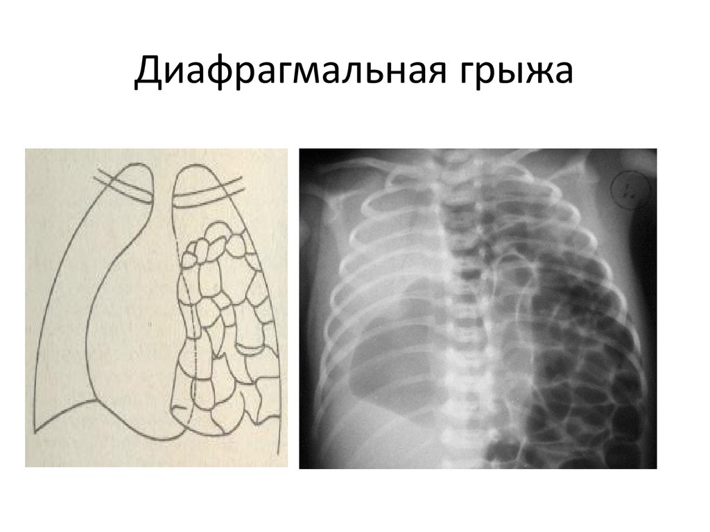 Врожденная диафрагмальная грыжа презентация