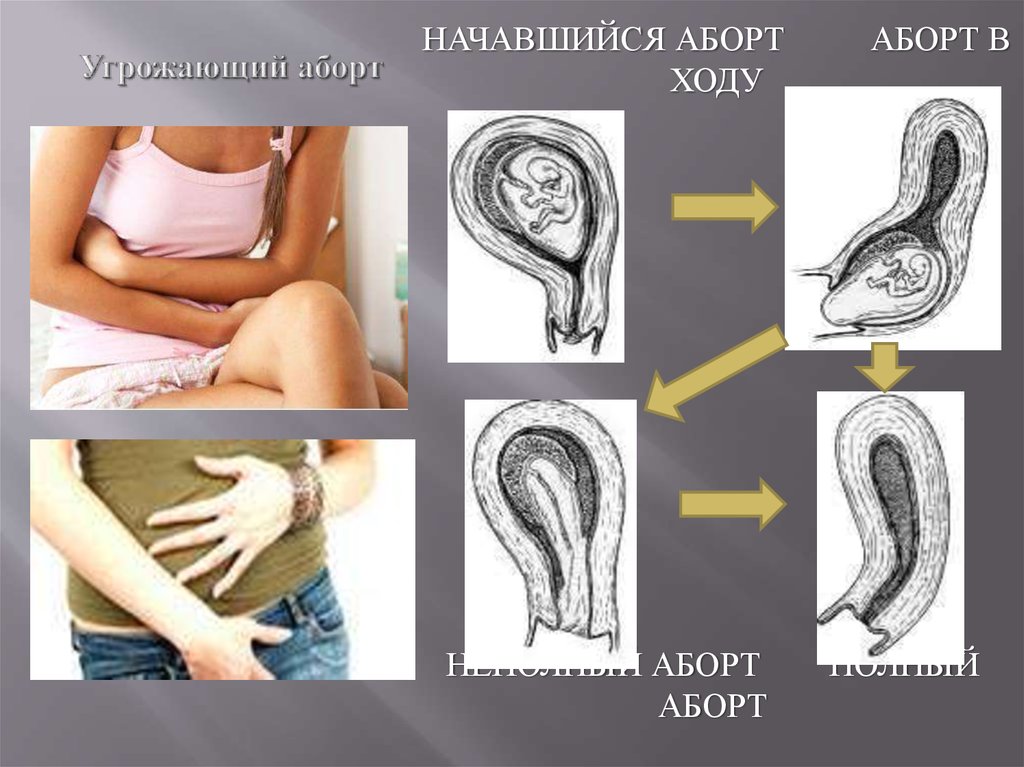 В ходу ли. Начавшийся самопроизвольный аборт. Самопроизвольный аборт в ходу. Неполный самопроизвольный аборт.
