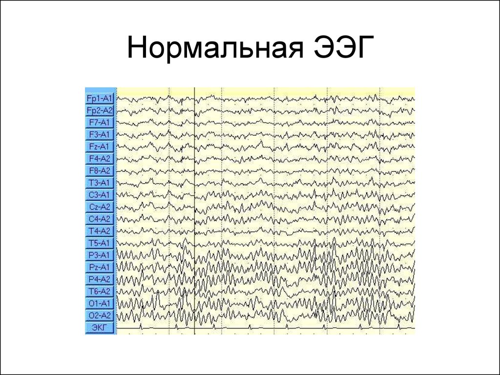 Здоровая ээг. Нормальная диаграмма ЭЭГ. Нормальный рисунок ЭЭГ. ЭЭГ головного мозга здорового человека график. Снимки ЭЭГ В норме.