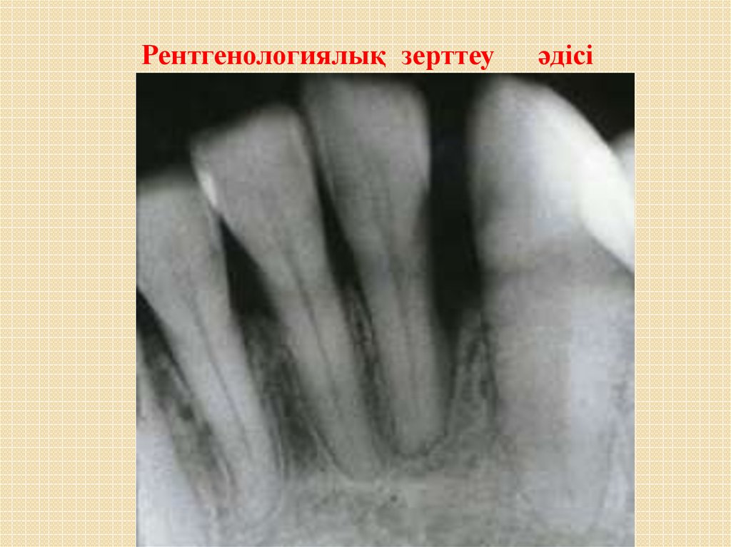 Рентгенологическая картина пародонтоз