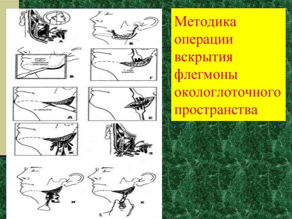 Методика операций. Методика операции вскрытия флегмоны окологлоточного пространства.. Вскрытие флегмоны окологлоточного пространства. Вскрытие абсцесса окологлоточного пространства. Окологлоточная флегмона.