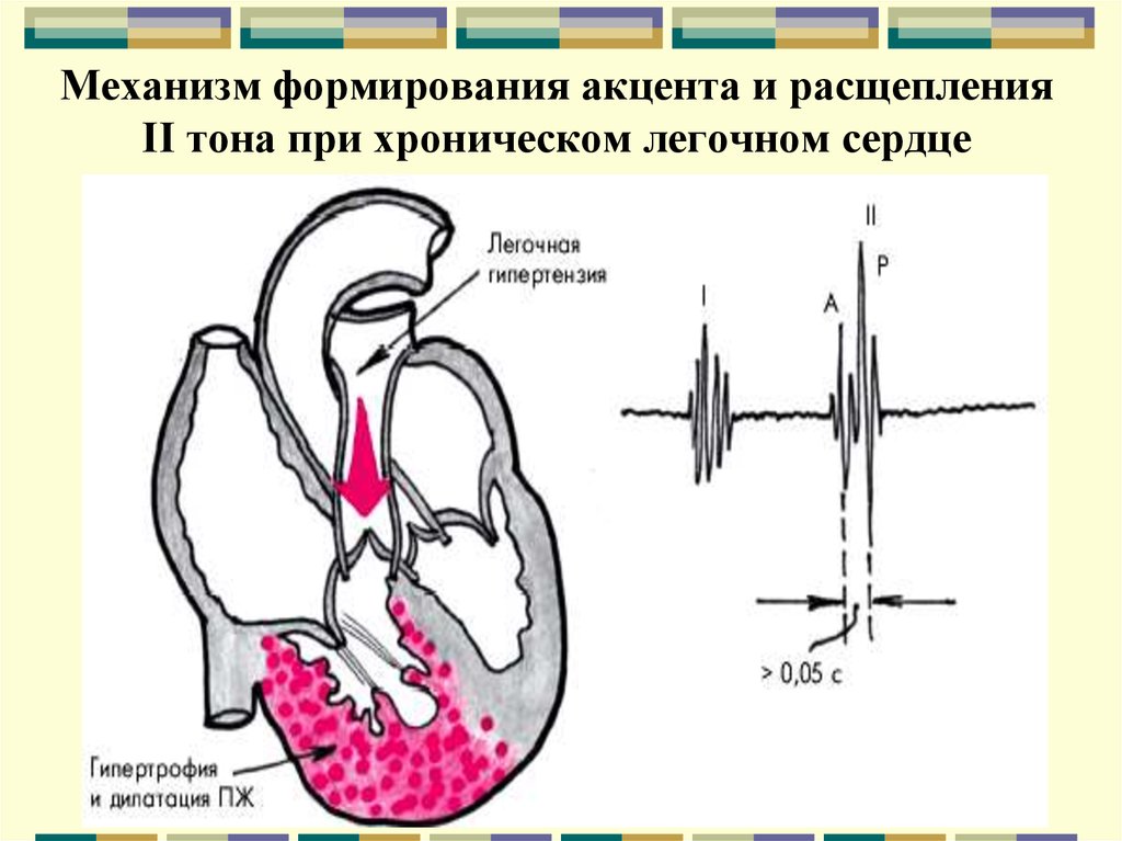 Хроническое легочное сердце это