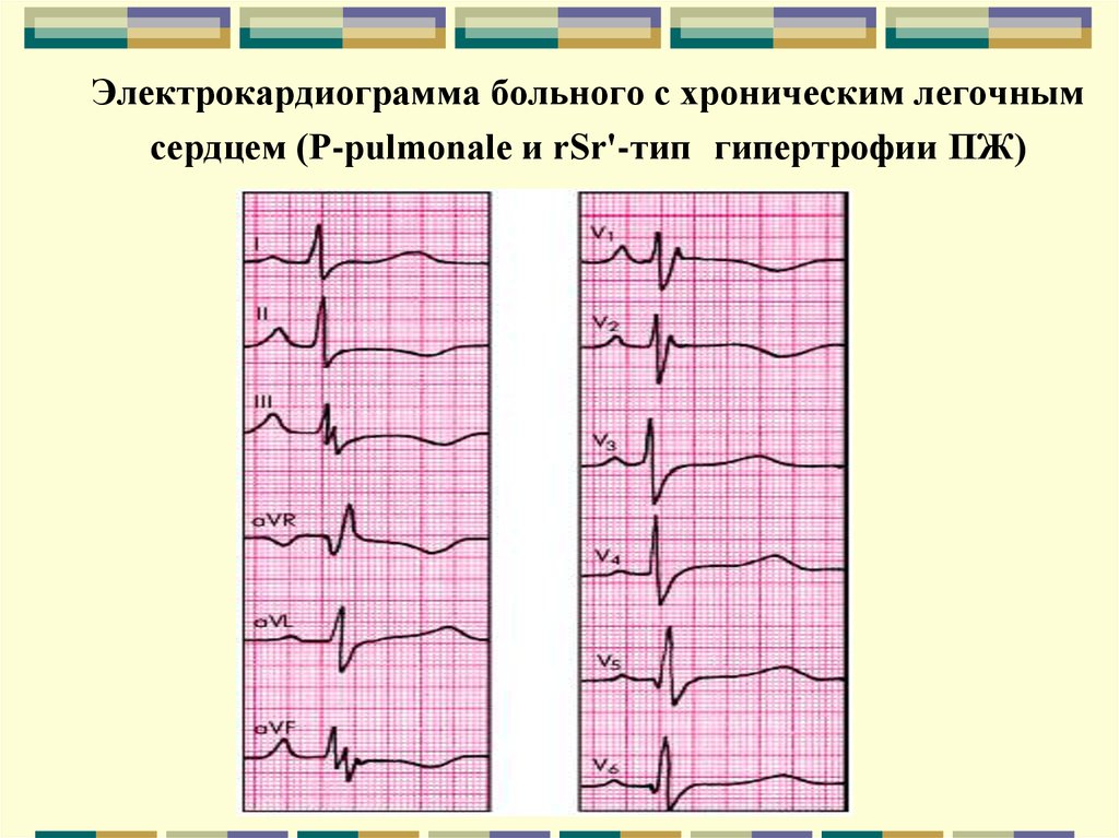 Экг пациентов