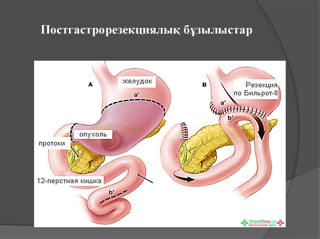 Схема операции бильрот 2