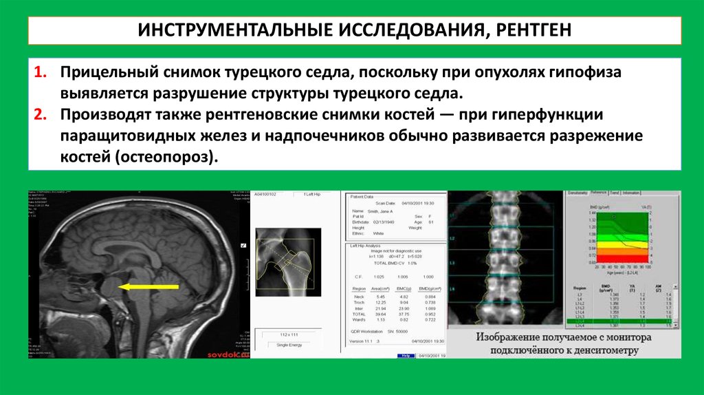 1 рентген. Опухоль гипофиза рентген. Гипофиза инструментальные исследования. Инструментальные методы исследования рентгеноскопия. Рентгенологические методы исследования эндокринной системы.