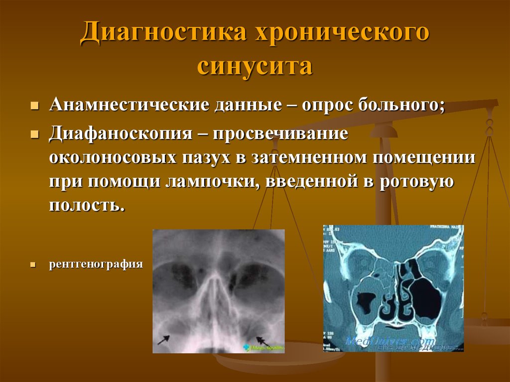 Заболевания придаточных пазух носа. Хронический гайморит диагноз. Риносинусит острый риносинусит. Диагноз фронтит гайморит. Клиническая картина синусита.