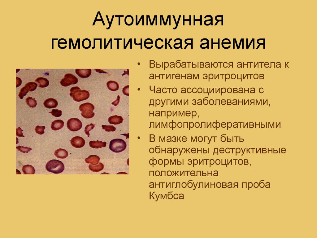 Анемия гемолитического типа. Аутоиммунная гемолитическая анемия картина крови. Гемолиз эритроцитов при гемолитической анемии. Иммунная гемолитическая анемия в ОАК. Кровь при приобретенных гемолитических анемиях.