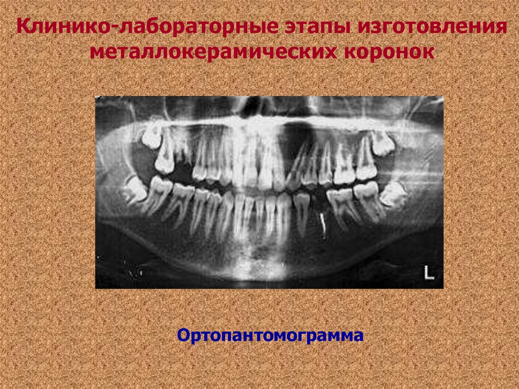 Лабораторные этапы металлокерамической коронки