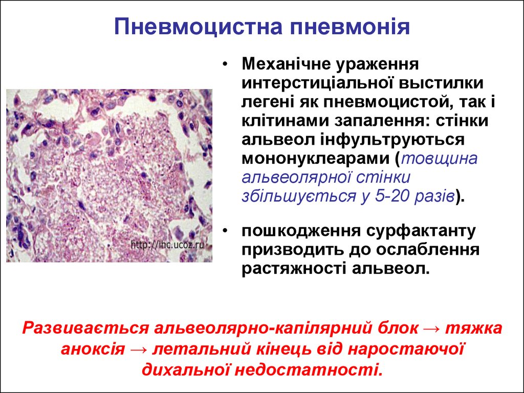 Пневмоцистная пневмония. Пневмоцистная пневмония гистология. Пневмоцистоз легких патанатомия. Пневмоцистная пневмония патанатомия. Пневмоцистная пневмония микро.