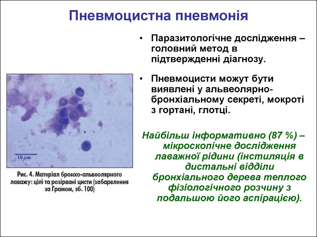 Пневмоцистная пневмония диагноз