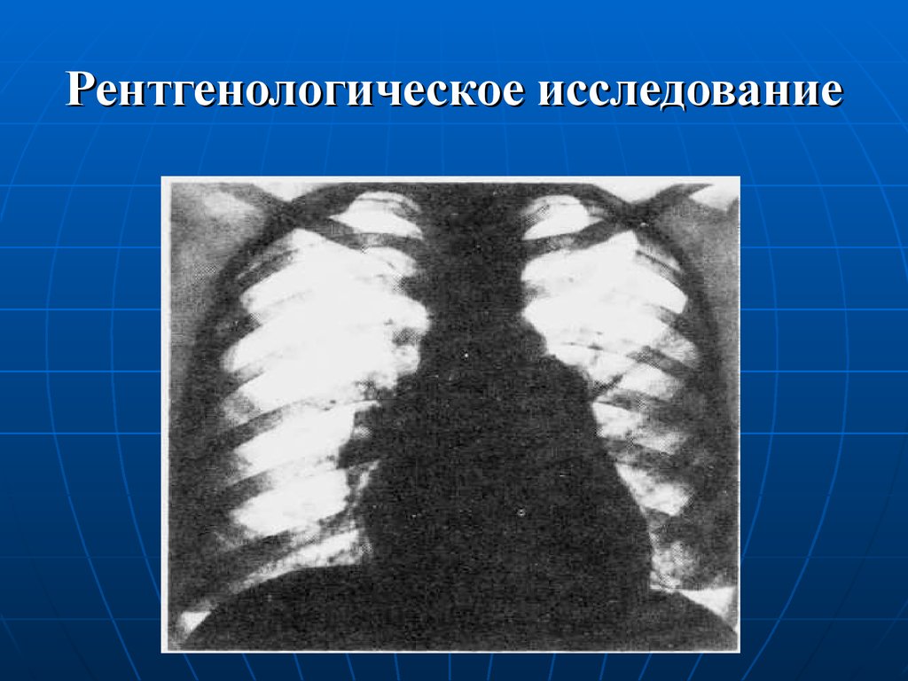 Острая ревматическая лихорадка картинки