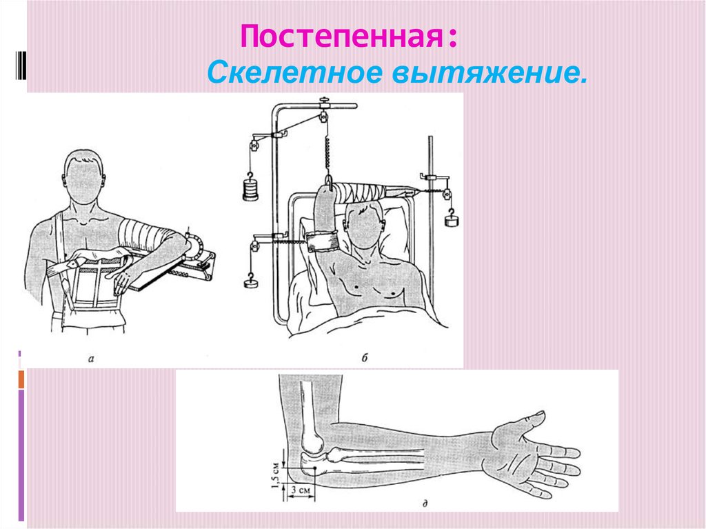 Скелетное вытяжение. Скелетное вытяжение локтевой отросток. Аппарат для скелетного вытяжения. Скелетное вытяжение при переломе плечевой кости. Скелетное вытяжение при переломе лопатки.