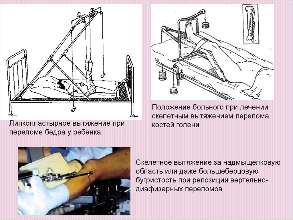 Схема скелетного вытяжения при переломах бедренной кости