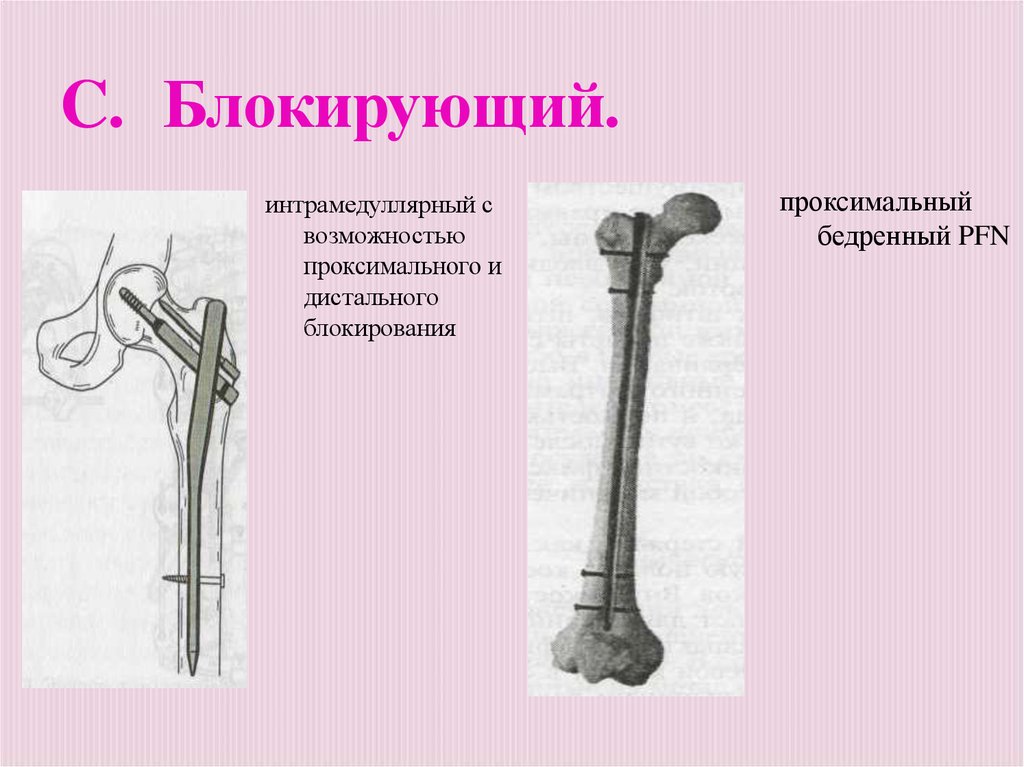 Проксимальный это. Проксимальной бедренный интрамедуллярный. Дистально и проксимально это. Проксимальный и дистальный. Проксимального интрамедуллярного штифта с блокированием (PFN).