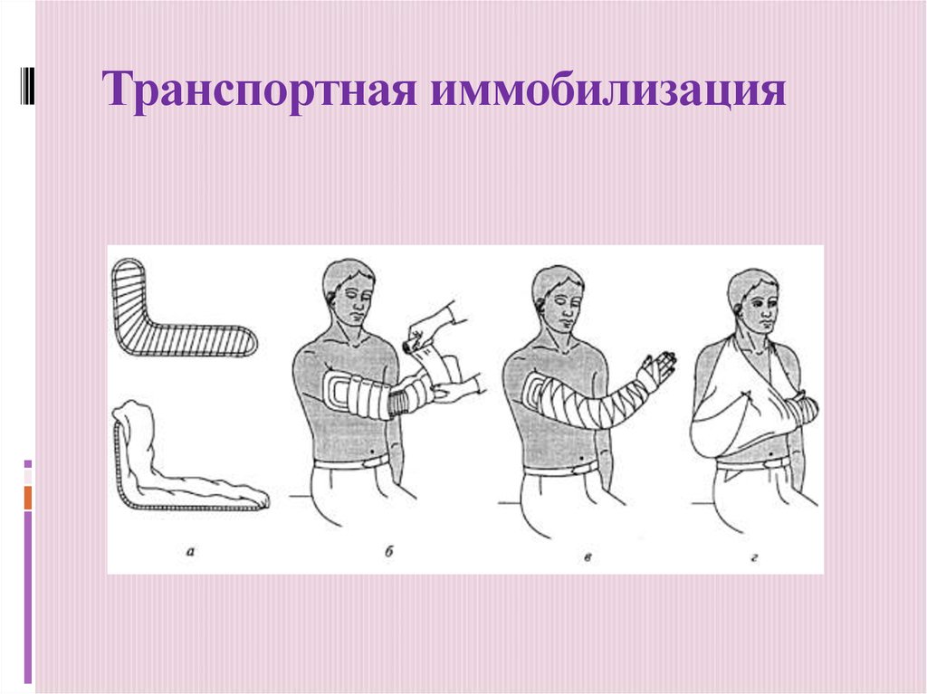 Правила проведения иммобилизации. Транспортная иммобилизация при вывихе тазобедренного сустава. Транспортная мобилизацация. Техника выполнения транспортной иммобилизации. Лубочные шины для иммобилизации.