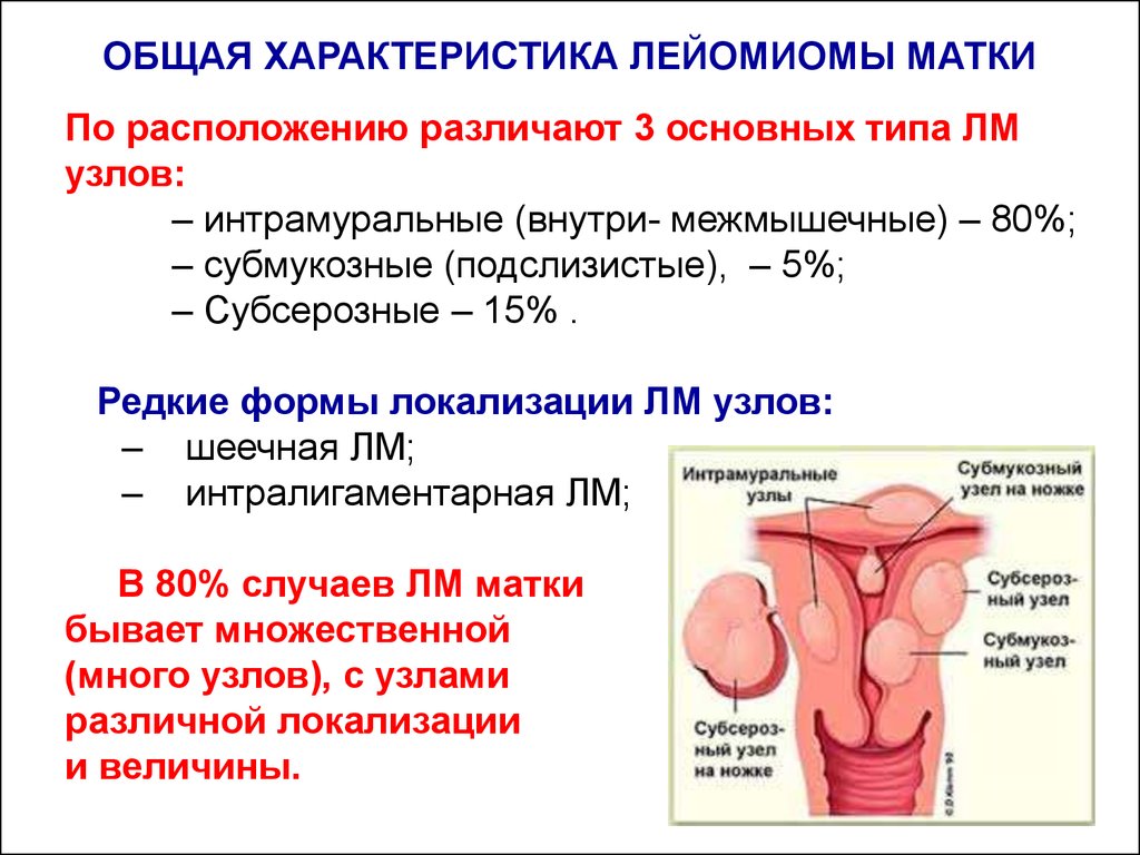 Лейомиома матки что это означает. Интрамуральная лейомиома матки. Патология шейки матки классификация. Интрамуральная-субсерозная лейомиома.