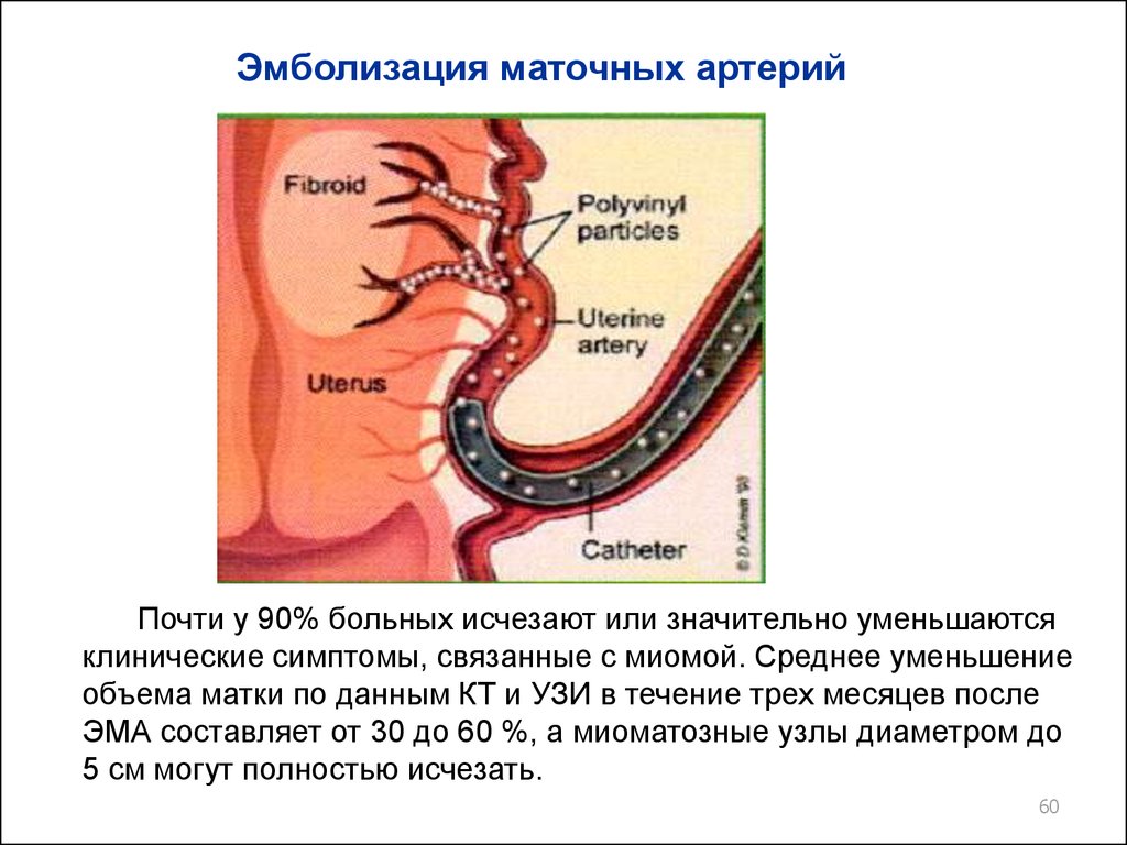 Эмболизация маточных артерий. Эмболизация показания. Эмболизация ветвей маточных артерий.