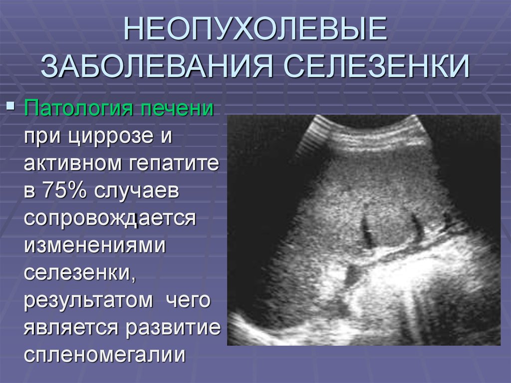 У подростка увеличена селезенка. Спленомегалия заболевания. Аномалии развития селезенки. Патология селезенки симптомы. Аномалия формы селезенки.