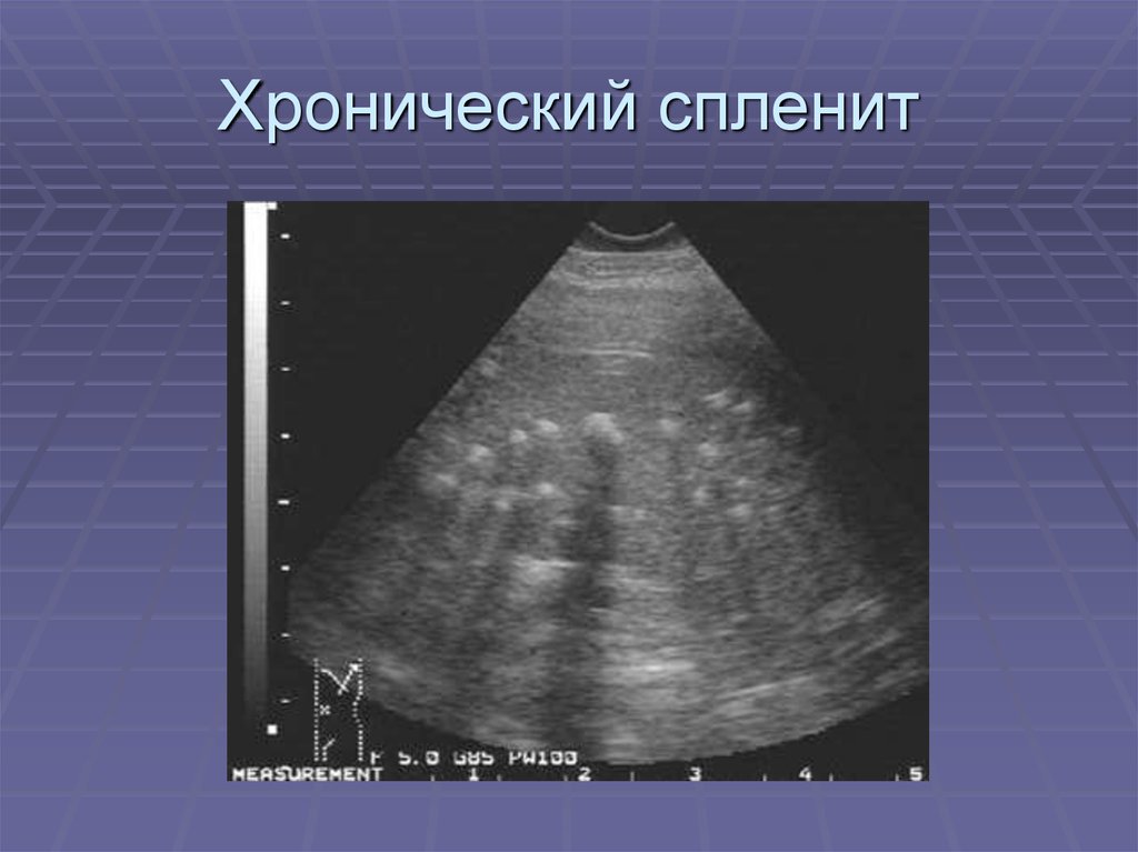 Синдром увеличения печени и селезенки