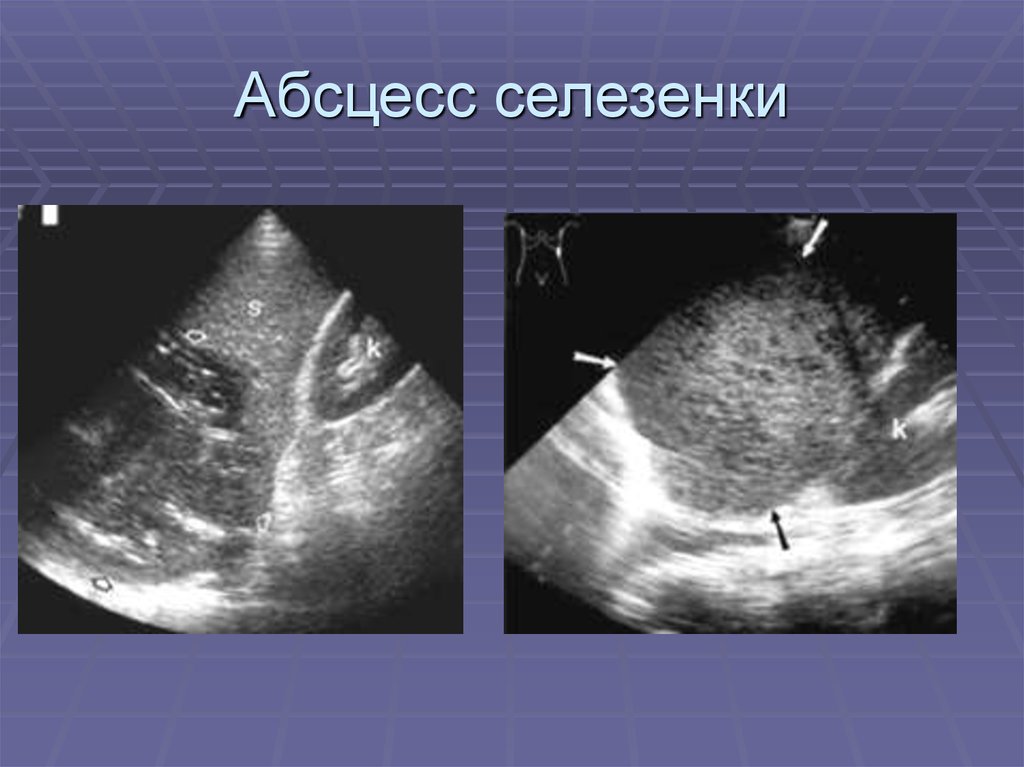 Узи селезенки. Абсцесс селезенки эхограмма. Абсцессы в печени и селезенке.