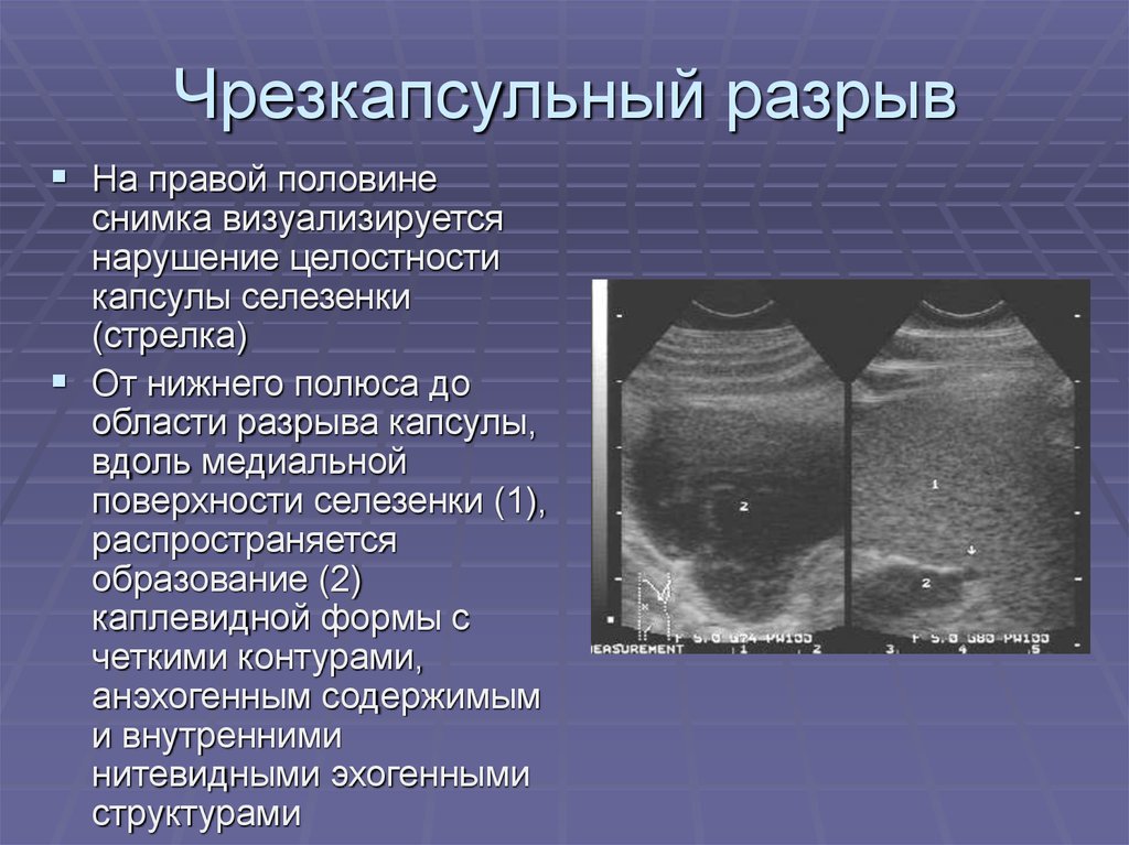 Травмы селезенки презентация