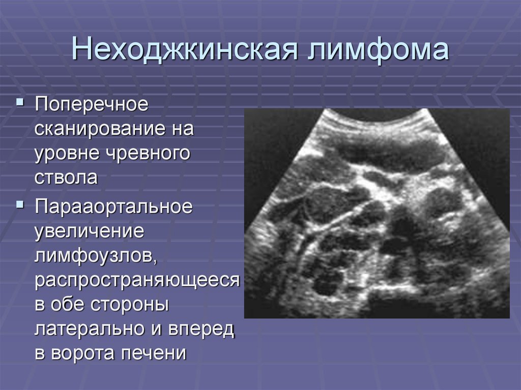 Узи лимфатических. Лимфома неходжкинская УЗИ лимфоузлов. УЗИ парааортальных лимфатических узлов. Неходжкинская лимфома УЗИ селезенки.