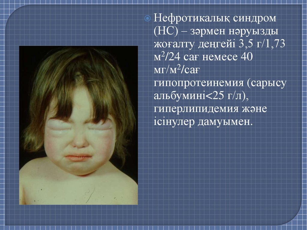 Синдром презентация. Нефротический синдром. Дети с гломерулонефритом взгляд. Нефротический синдром фото людей.