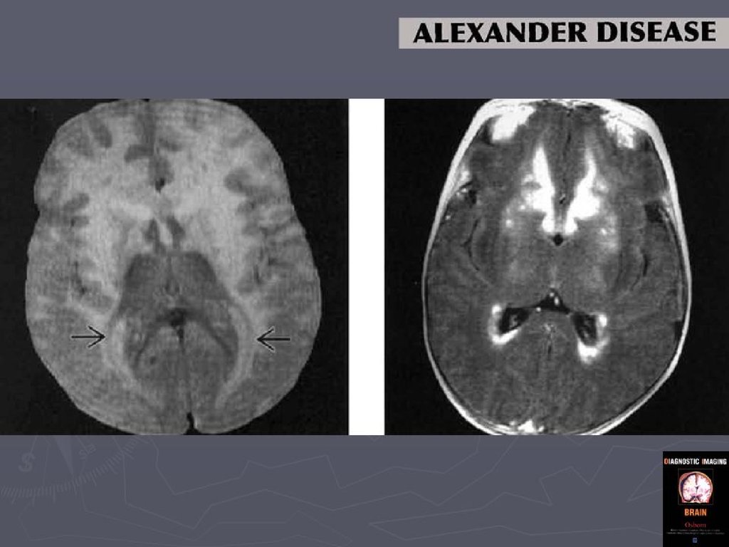 Лейкодистрофия это. Лейкодистрофия Александера мрт. Гипомиелинизирующая лейкодистрофия. Лейкодистрофия Краббе Бенеке.