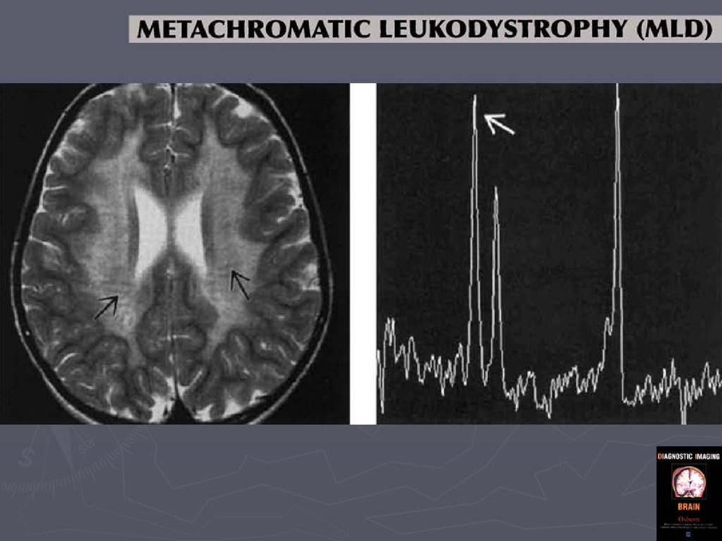 Лейкодистрофия это. Гипомиелинизирующая лейкодистрофия. Метахроматическая лейкодистрофия. Лейкодистрофия Канавана.