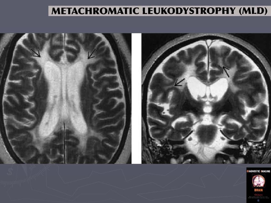 Лейкодистрофия это. Лейкодистрофия головного мозга мрт. Метахроматическая лейкодистрофия мрт. Лейкодистрофия Александера мрт. Лейкодистрофия гипомиелиновая.