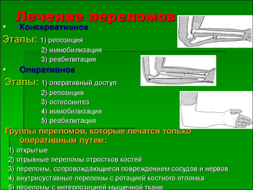 Травматология переломы презентация