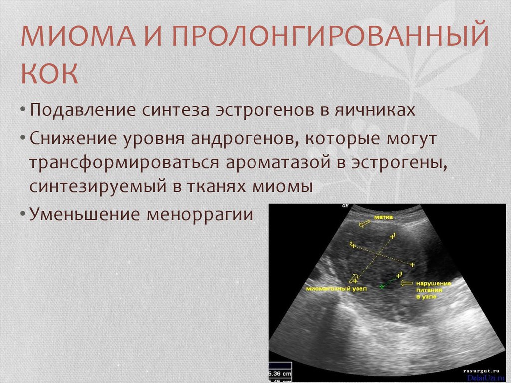 Эстрогены миома. Пролонгированный Кок. Кок при эндометриозе и миоме.